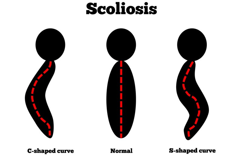 Newton Abbot, Devon scoliosis treatment
